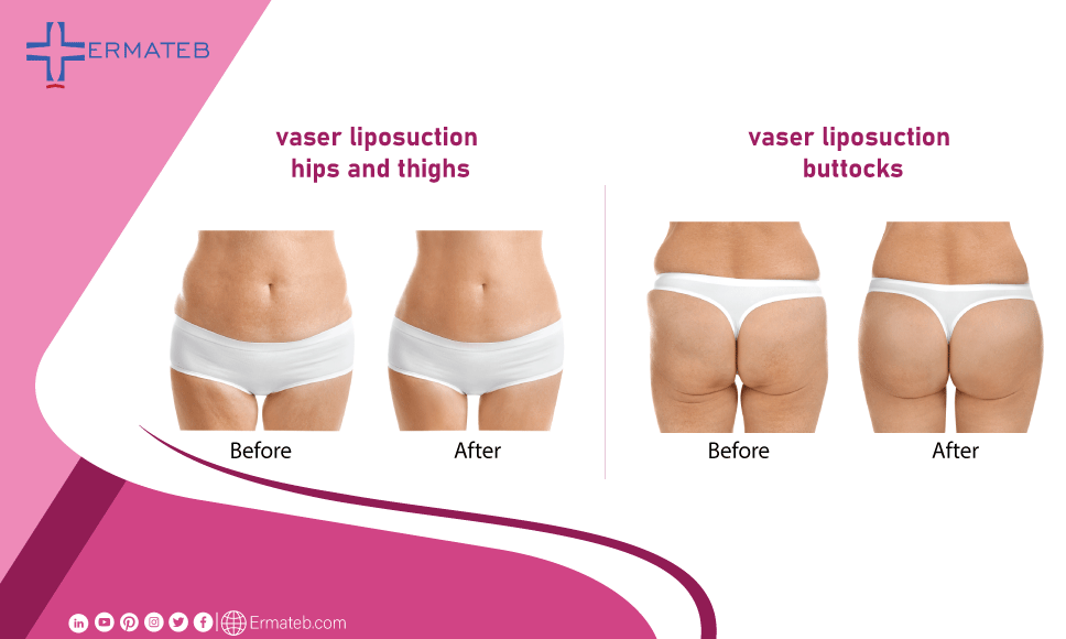vaser liposuction of hip and thighs, vaser liposuction of buttocks